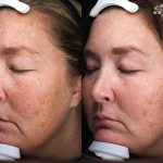 Antioxidant Facial Peel Treatment