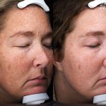 Antioxidant Facial Peel Treatment 16 Weeks