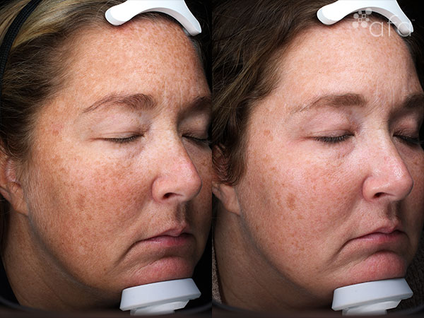 Antioxidant Facial Peel Treatment 16 Weeks