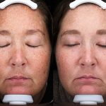 Antioxidant Facial Peel Treatment 16 Weeks