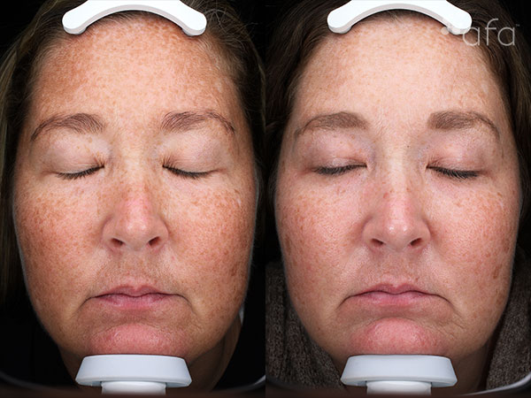 Antioxidant Facial Peel Treatment 16 Weeks