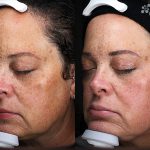 Antioxidant Facial Peel Treatment 16 Weeks
