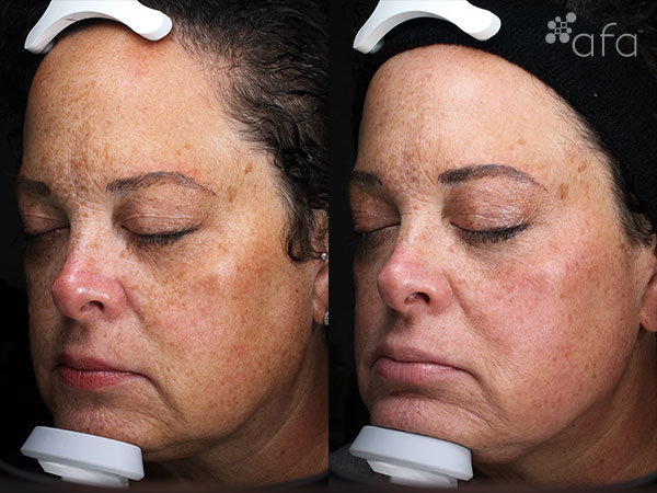 Antioxidant Facial Peel Treatment 16 Weeks