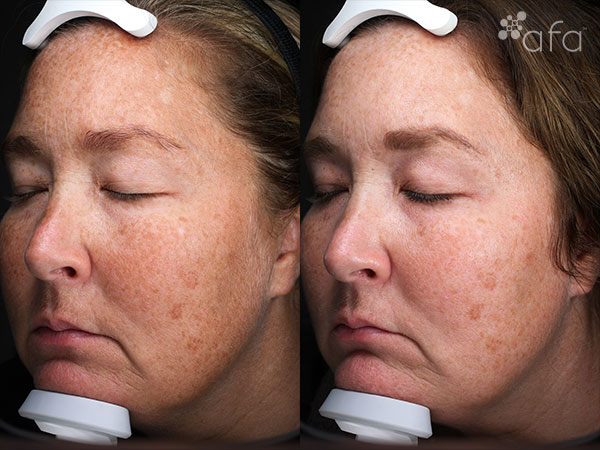 Antioxidant Facial Peel Treatment