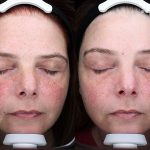 At-home Regimen Treatment 16 Weeks