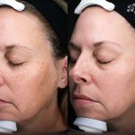 At-home Regimen Treatment 16 Weeks