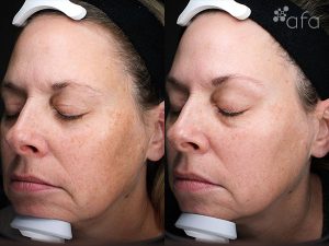 At-home Regimen Treatment 16 Weeks