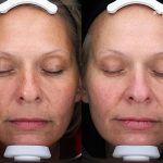 At-home Regimen Treatment 16 Weeks