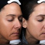 Clay Peel Treatment 16 Weeks