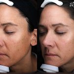 Clay Peel Treatment 16 Weeks