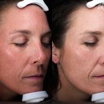 Clay Peel Treatment 16 Weeks