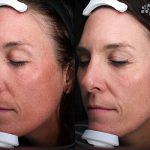 Clay Peel Treatment 16 Weeks