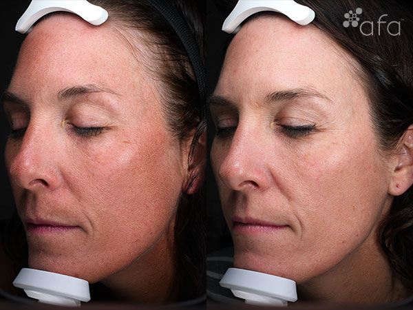 Clay Peel Treatment 16 Weeks