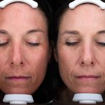 Clay Peel Treatment 16 Weeks