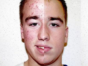 Acne Treatment after 1 year