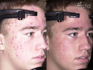 Acne Treatment after 3 Months