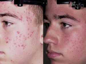 Acne Treatment after 3 Months
