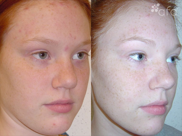 Acne Treatment after 7 months