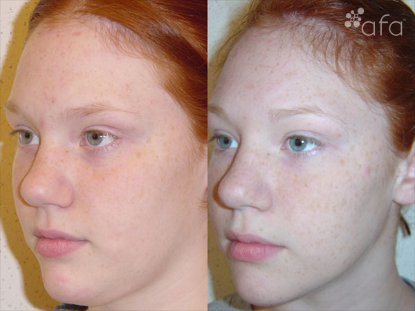 Acne Treatment after 7 months