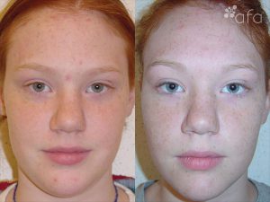 Acne Treatment after 7 Months