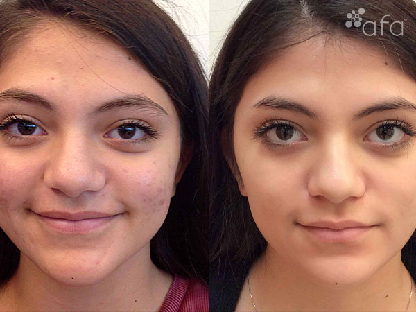 Acne Treatment after 7 Months