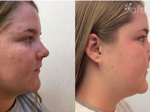 Acne Treatment after 6 months