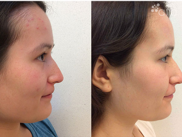 Acne Treatment after 9 months