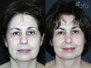 Fine Lines & Wrinkles after 45 Days