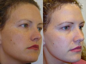 Hyperpigmentation Treatment after 4 Months