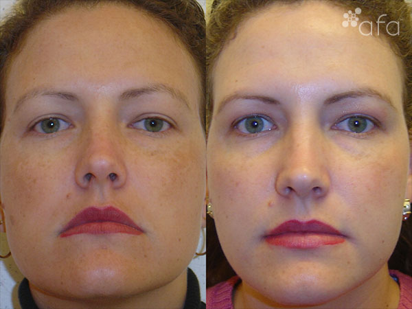 Hyperpigmentation Treatment after 4 Months