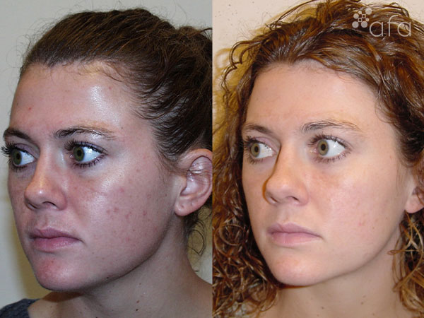 Hyperpigmentation Treatment after 5 Months