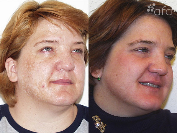Hyperpigmentation Treatment after 3 Months