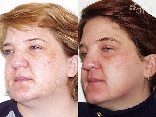 Hyperpigmentation Treatment after 3 Months