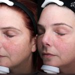 At-home Regimen Treatment 16 Weeks